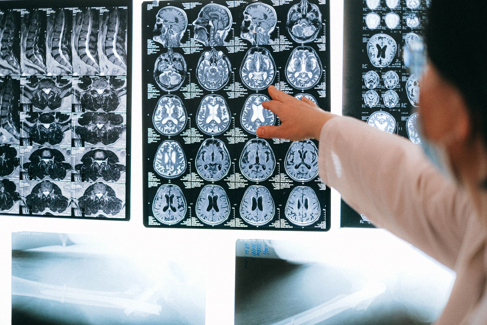 Medico che osserva una TAC cerebrale sullo schermo
