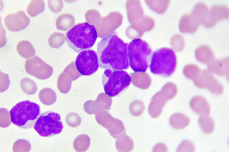 Leucemia mieloide acuta